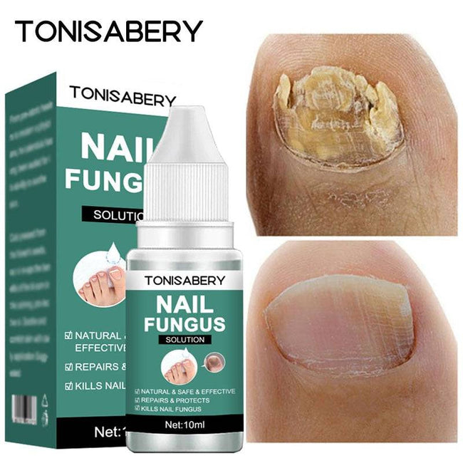 Nail Fungal Treatment Feet Care Essence  Anti Infection Paronychia Onychomycosis Nail Foot Toe Nail Fungus Removal Gel Products - TheWellBeing4All