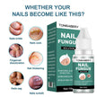 Nail Fungal Treatment Feet Care Essence  Anti Infection Paronychia Onychomycosis Nail Foot Toe Nail Fungus Removal Gel Products - TheWellBeing4All