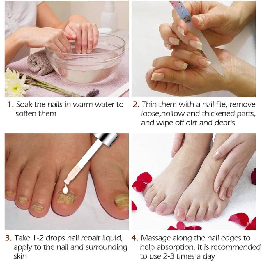 Nail Fungal Treatment Feet Care Essence  Anti Infection Paronychia Onychomycosis Nail Foot Toe Nail Fungus Removal Gel Products - TheWellBeing4All