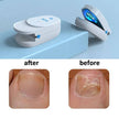 Nail Treatment Laser Device For NaiL. Removal Anti Infection Paronychia Ony chomycosis Care - TheWellBeing4All