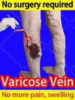 Varicose vein relief cream to relieve vasculitis phlebitis spider treatment - TheWellBeing4All