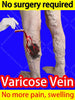 Varicose vein relief cream to relieve vasculitis phlebitis spider treatment - TheWellBeing4All