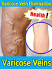 Varicose vein relief cream to relieve vasculitis phlebitis spider treatment - TheWellBeing4All