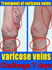 Varicose vein relief cream to relieve vasculitis phlebitis spider treatment - TheWellBeing4All