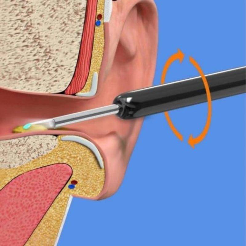 Visible wax elimination spoon load otoscope Ear Cleaner Ear wax removal tool Suitable for Android iOS phones - TheWellBeing4All